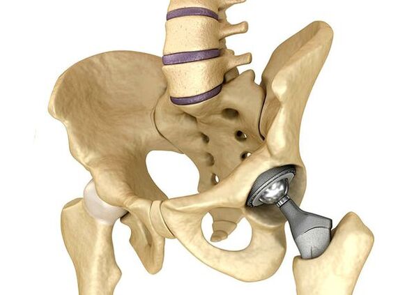 The endoprotetics of the thigh joint