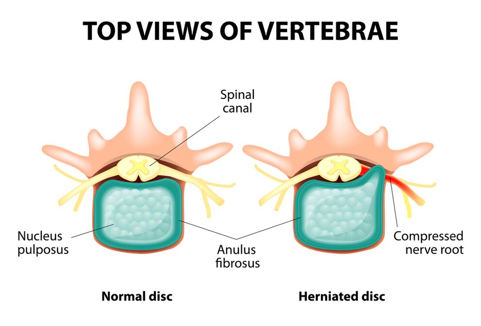 Healthy intervertebral disc and hernia