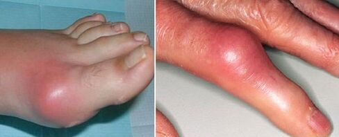 Appearance of joints with arthritis