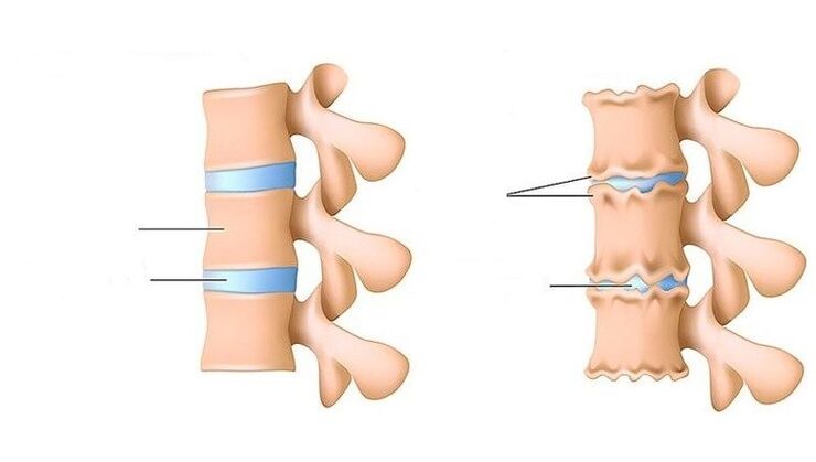 Healthy spine and spine with osteochondrosis