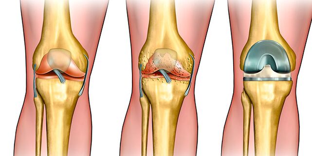 At the third stage of arthrosis, knee replacement is required