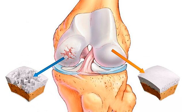 Normal knee joint (right) and arthrosis (left)