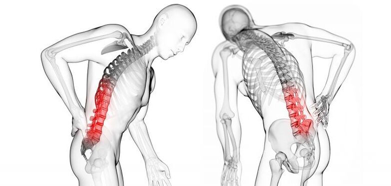 Complications of cervical osteochondrosis